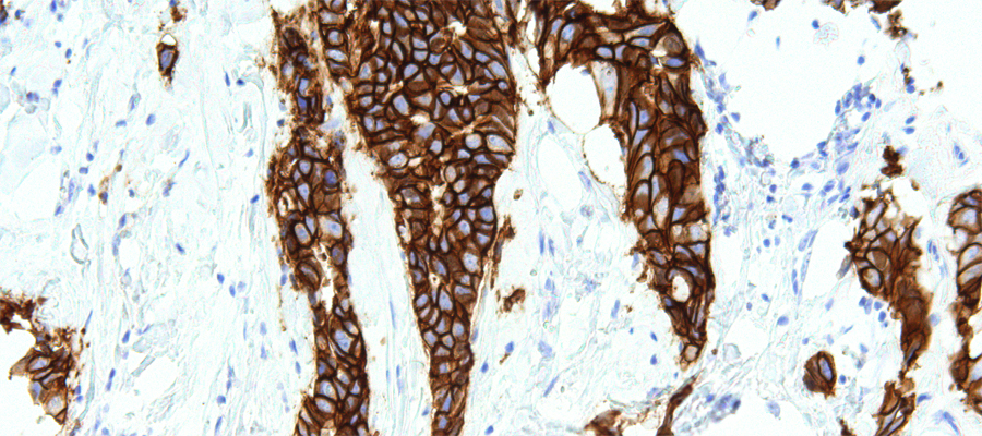 Her 2 staining on patient breast cancer tissue. (Attribution: GenomeMe Lab Inc. [CC BY 4.0], via Wikimedia Commons)