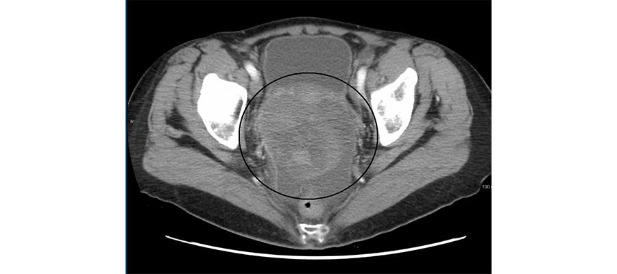 An ovarian cancer as seen on computer tomography scan (By James Heilman, MD [CC BY-SA 3.0])