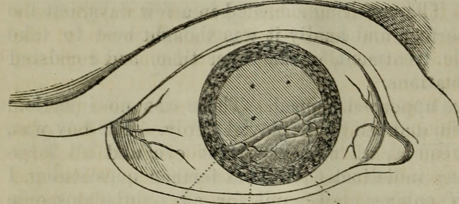 Retinal detachment